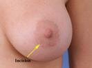 breastimplant.jpg